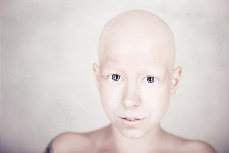 Alopecia universalis