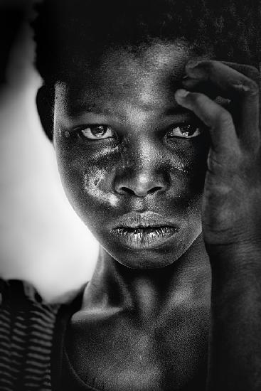 Vernarbtes Mädchen - Benin (Afrika)